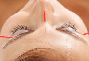 Quand acupuncture et esthétique vont de pair. DR Quand acupuncture et esthétique vont de pair. DR