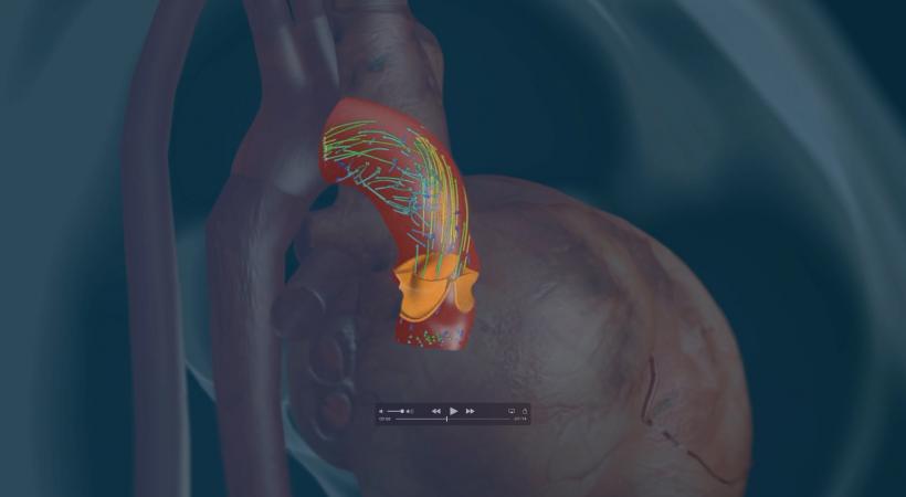 Le projet de coeur virtuel "iHeart" pourrait aider les cliniciens à gérer des questions importantes. EPFL