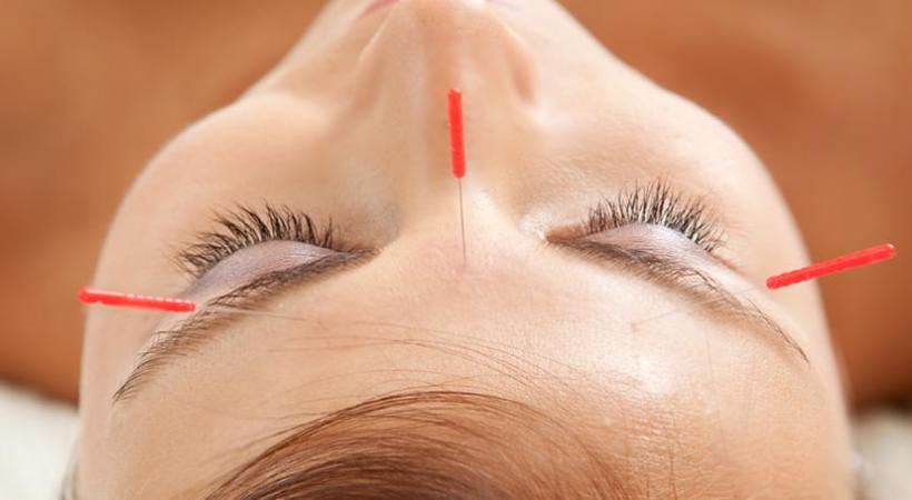  Quand acupuncture et esthétique vont de pair. DR